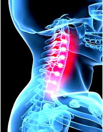 Osteokondroosi kliiniline pilt